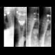 Bezoar of oesophagus: RF - Fluoroscopy